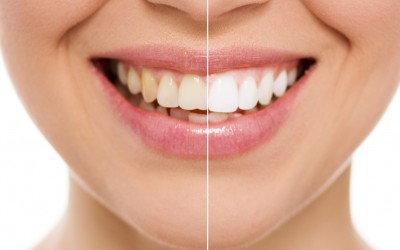 Blanqueamiento dental